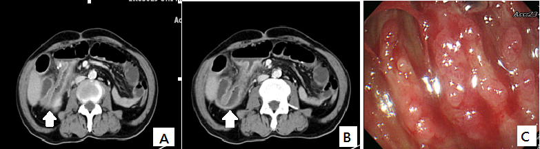 Figure 1. The CT of the abdomen shows segmental small bowel swelling at distal ileum till anastomosis (arrow, A), causing proximal small bowel partial obstruction (arrow, B). Colonoscopy through the right-sided colostomy reveals diffuse hemorrhagic erosions and ulcers at the ileum (C).