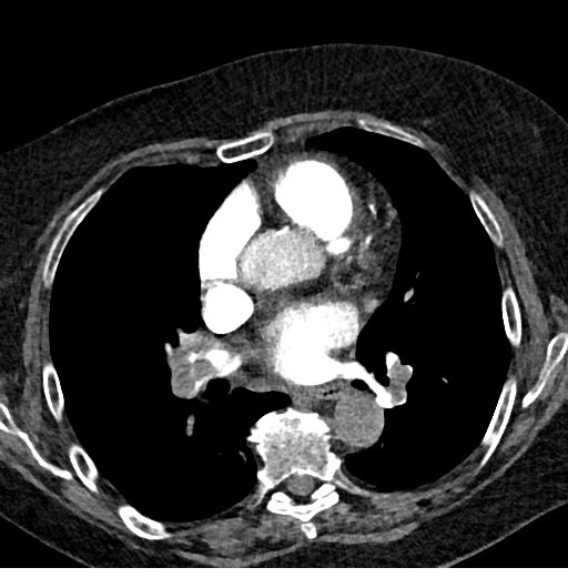 Figure 1. CT scan showing massive bilateral pulmonary emboli and RV strain