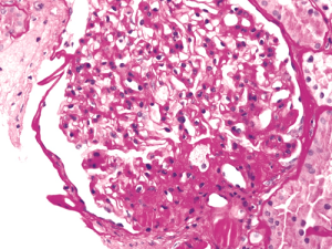 Figure 2. Obesity-related perihilar focal segmental glomerulosclerosis on a background of glomerulomegaly. Periodic Acid-Schiff stain, original magnification 400x
