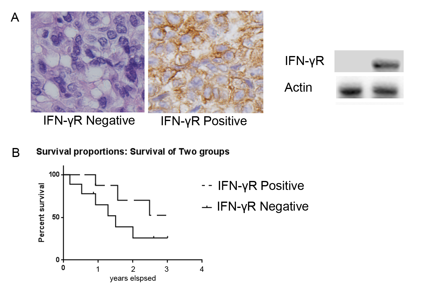 Figure 1. Representative IFN-γR immunostaining in NPC and effects of IFN-γR expression on patient’s survival. A: IFN-γR expression is positive in some patients and negative positive in others. B: In the patients that received concurrent chemotherapy with radiation therapy (55 out of 70), the survival rate of patients with low IFN-γR expression was significantly higher than that of patients with high IFN-γR expression (p = 0.001).