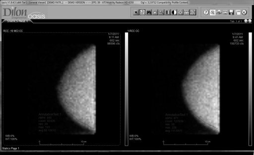 Figure1. Examples of breast images taken at a low dose and at the normal dose showing the regions used to determine the average count density in each.  The total counts in the region and the number of pixels in the region were used to calculate the average count/pixel value.
