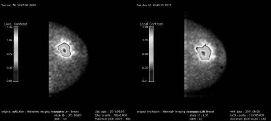 Figure 2.  Examples of breast images taken at a low dose and at the normal dose showing the area where the local contrast was calculated.  The algorithm calculates the average counts in the breast and then highlights the pixels in areas where this average value is exceeded and calculates the contrast.