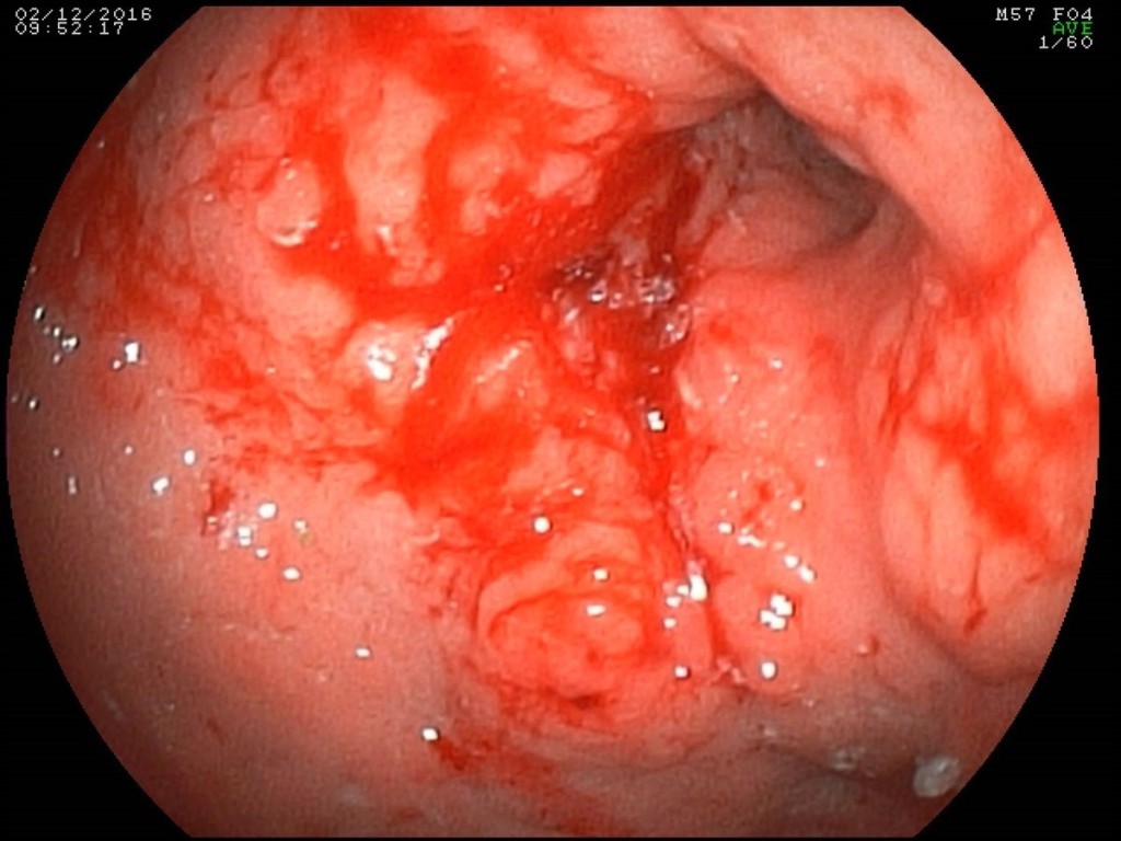 Figure 1. Endoscopic picture of a circular infiltrative tumor of the antral and stomach body with ulceration.