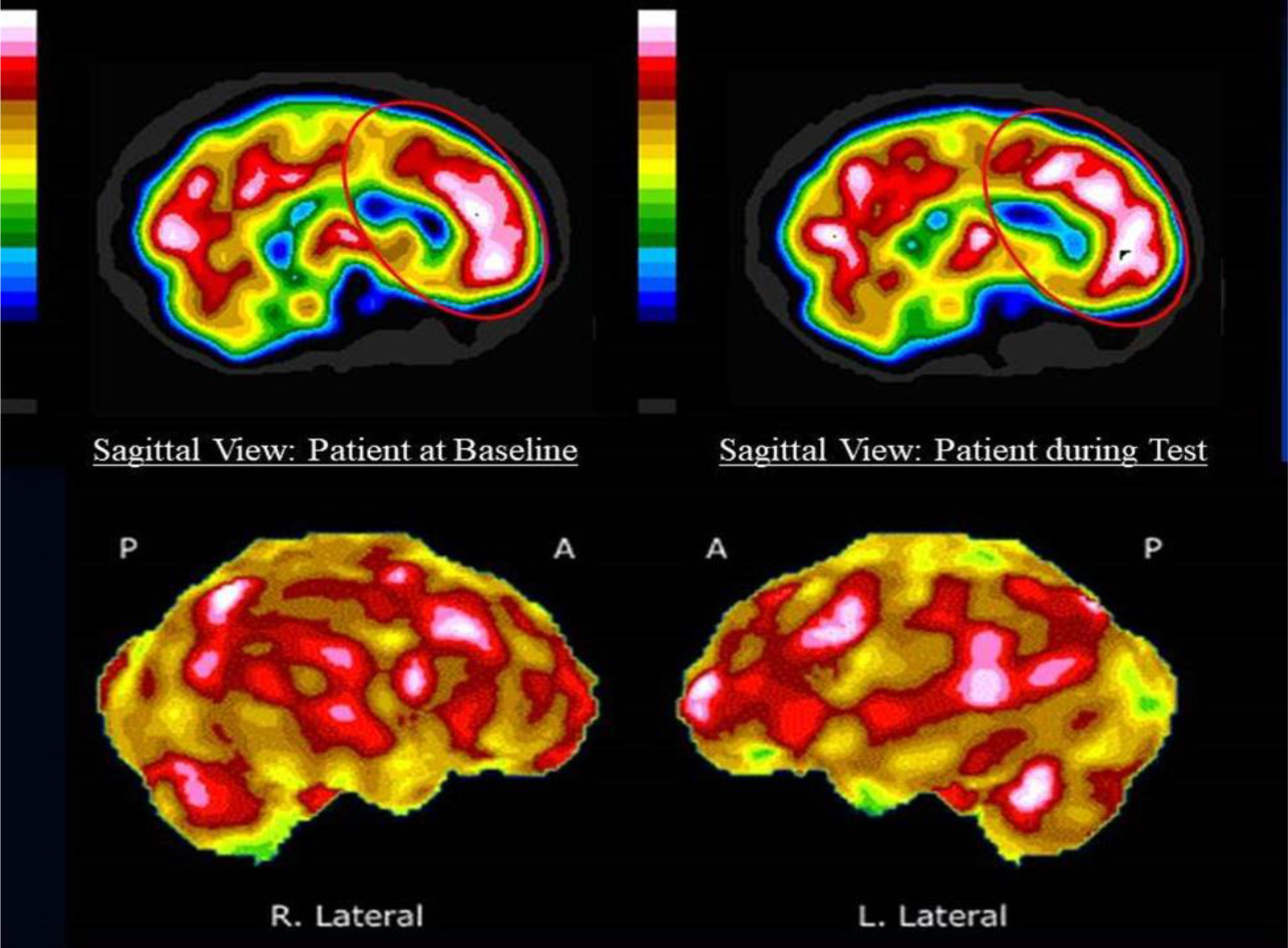 fMRI vs. SPECT Scan for the Brain