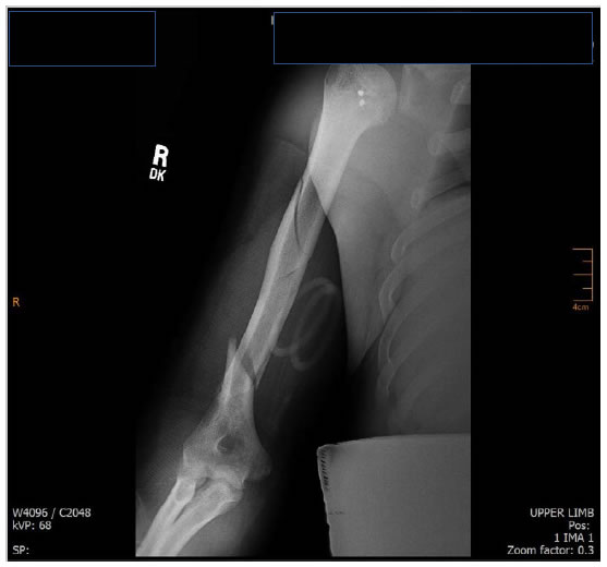 closed fracture of proximal end of right humerus