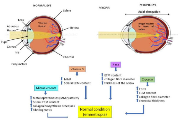pathological myopia causes