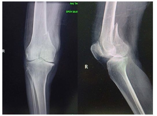 medial femoral condyle fracture